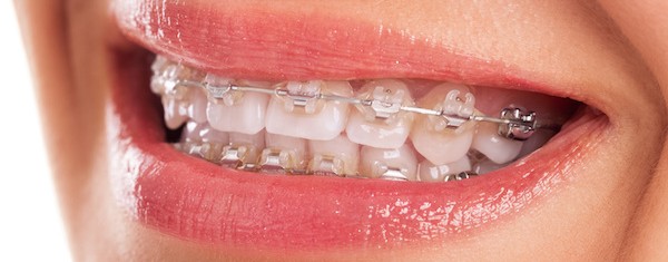 Metal Braces VS Clear Braces - Bali Implant Aesthetic (BIA) Dental Center